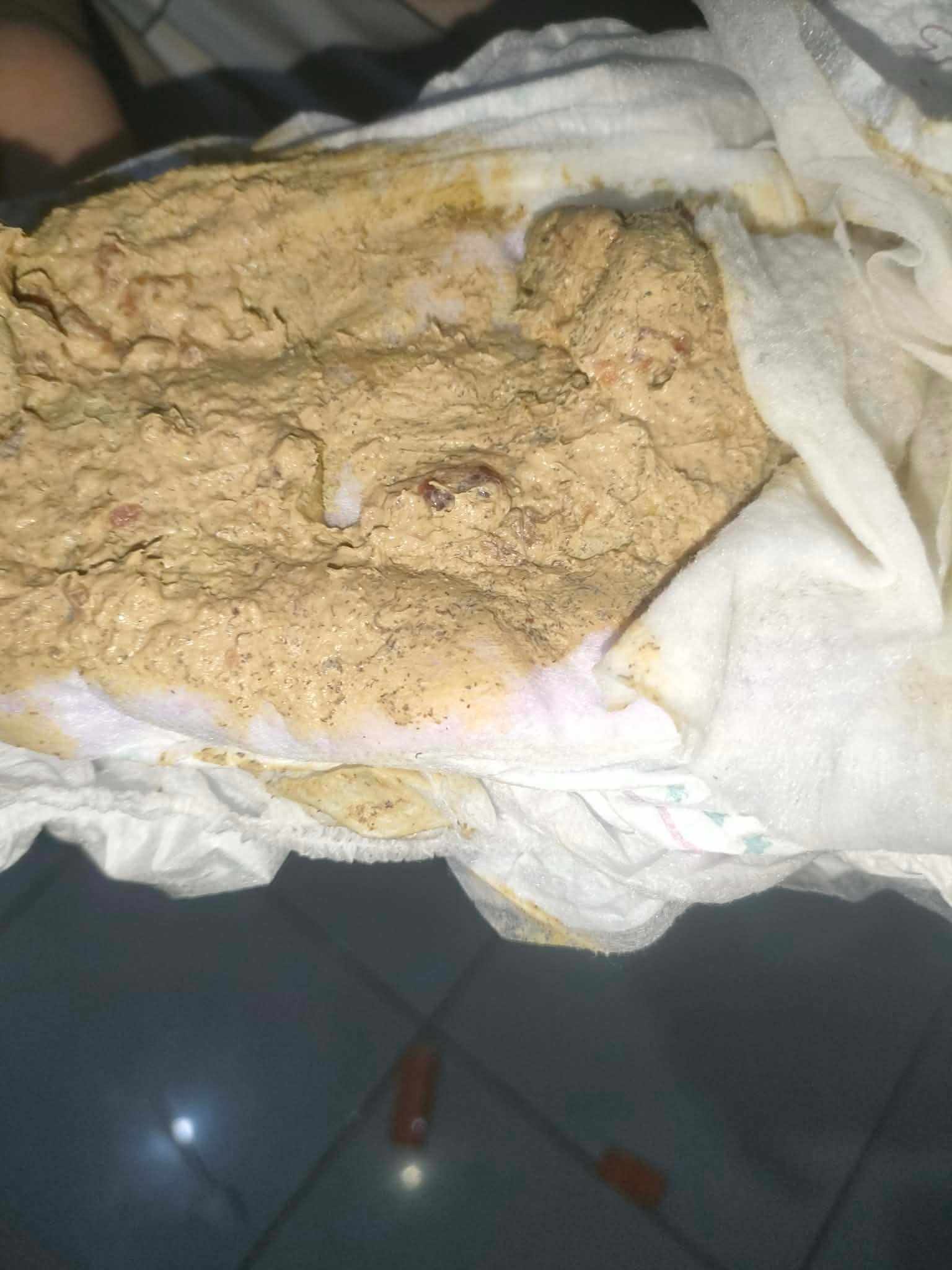 ما سبب البراز بلون الطحينة؟