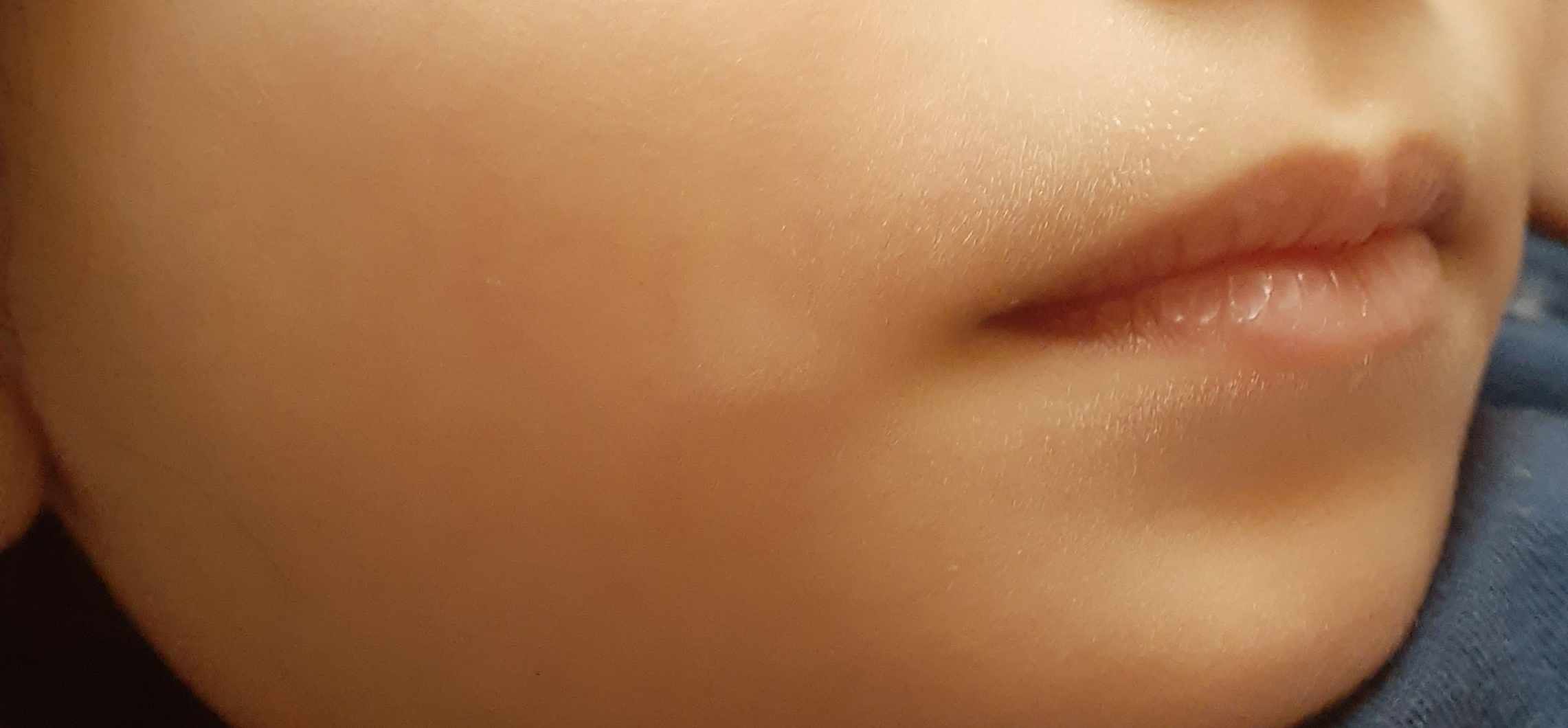 بقع بيضاء على الجسم منذ الولادة
