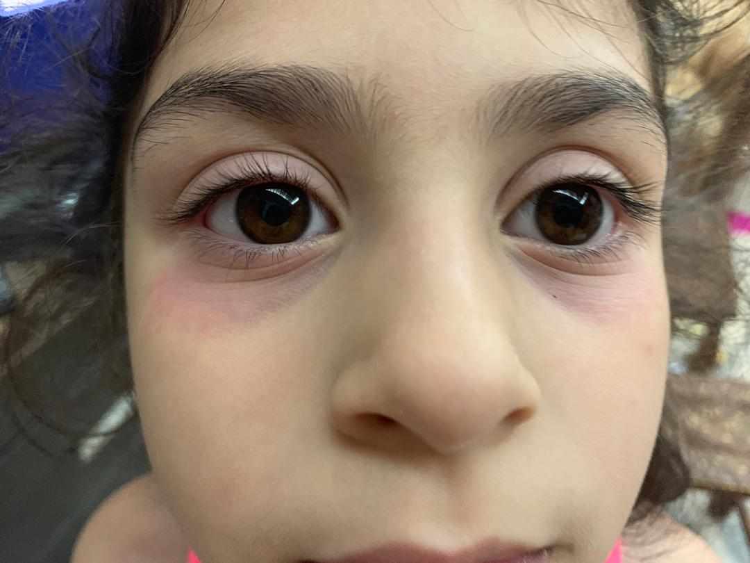 للاطفال احمرار العين أمراض والتهابات