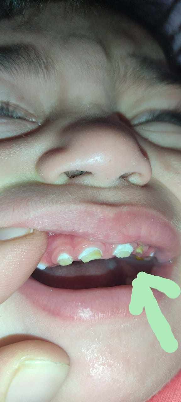 نقص تكون مينا الأسنان عند الأطفال