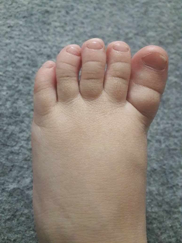 ميلان اصابع قدم الطفل