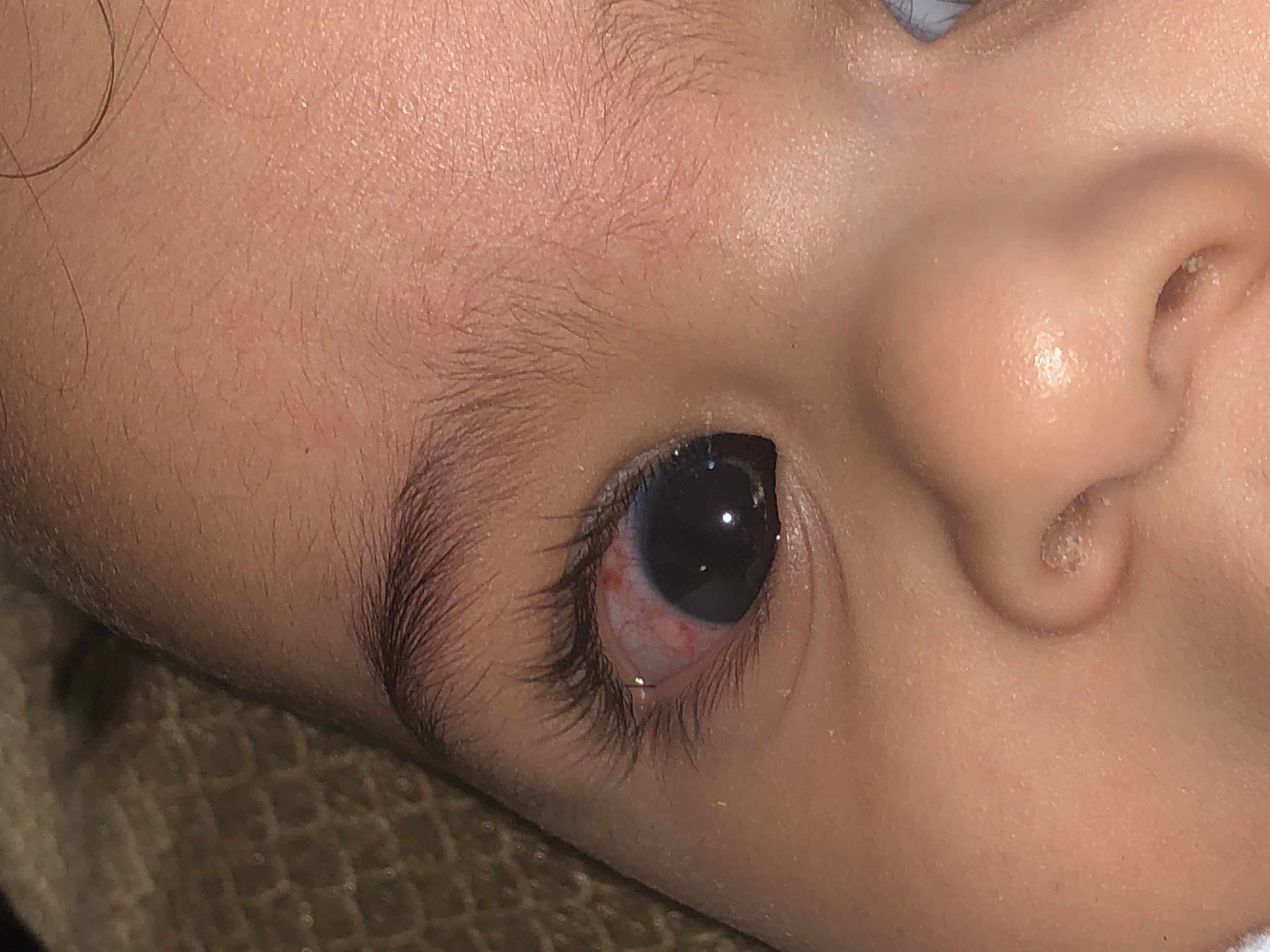 احمرار عين طفلي