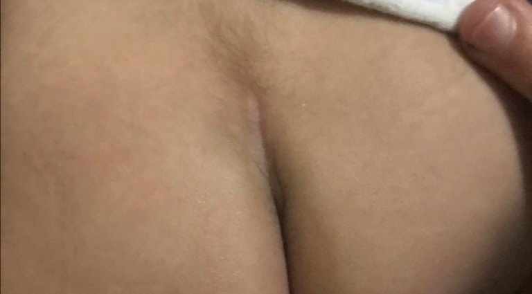 سبينا بيفيدا عند الرضع