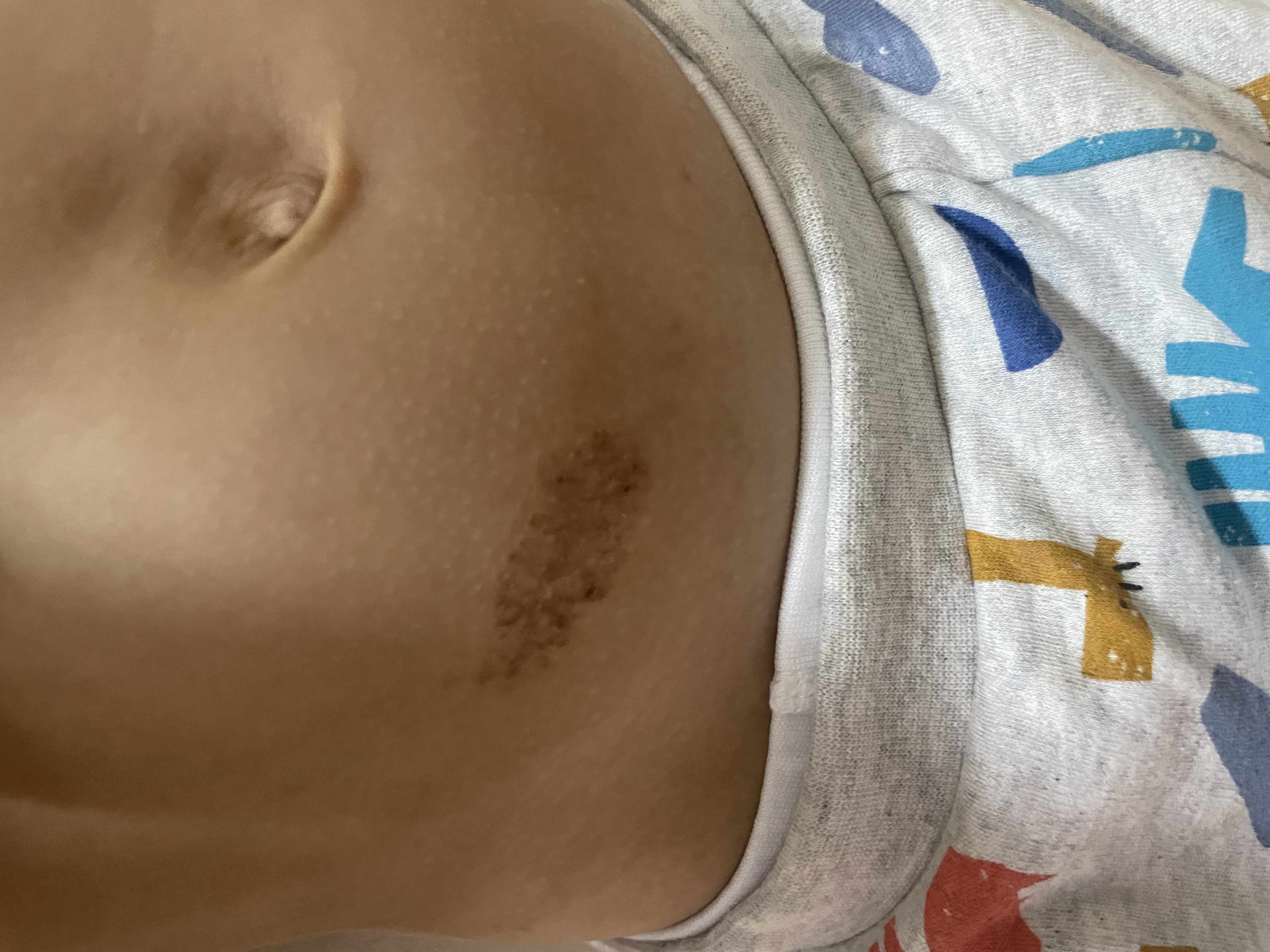 حساسية جلد الطفل اسفل البطن واسفل الظهر