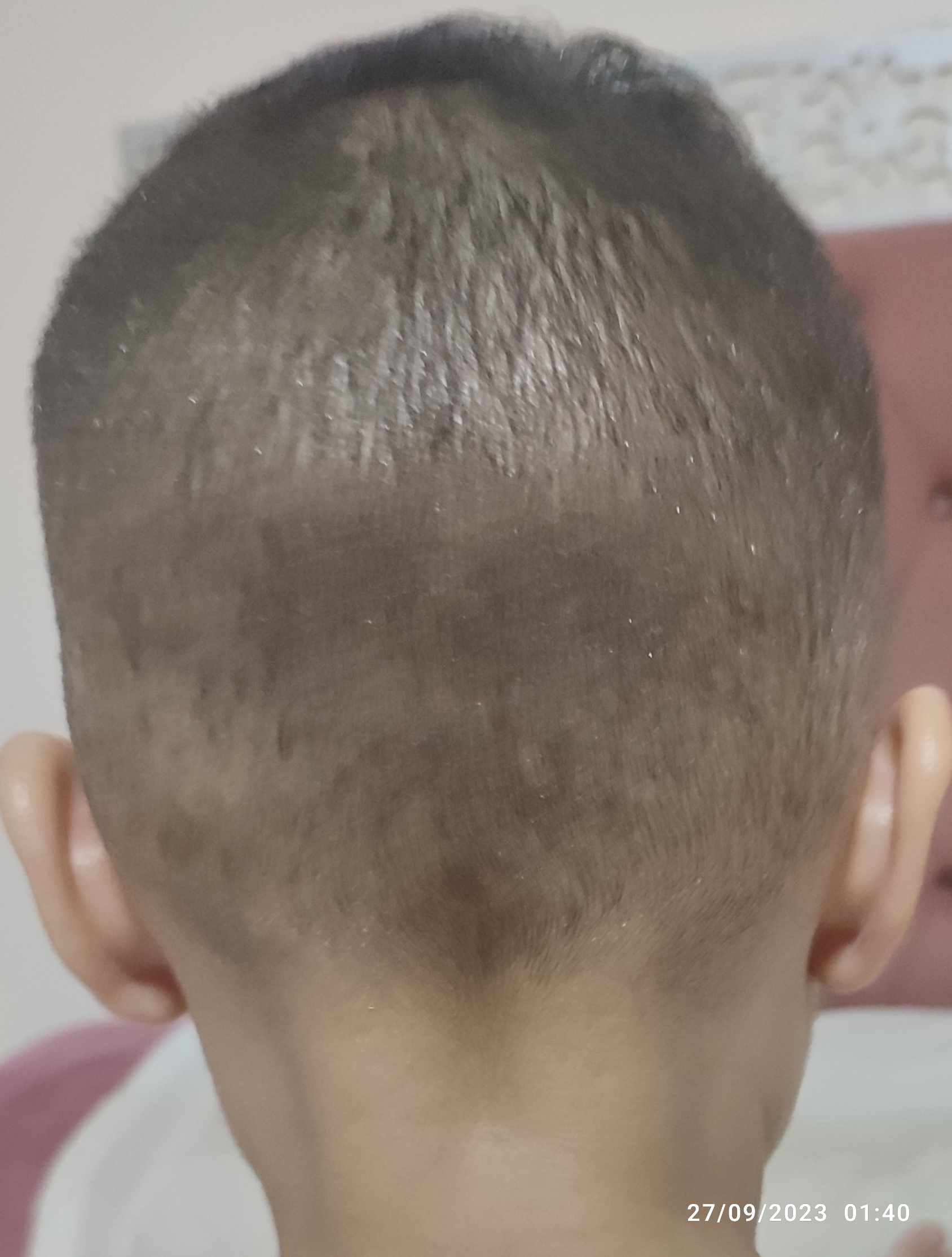 بروز الجمجمة من الخلف: 4 أسباب