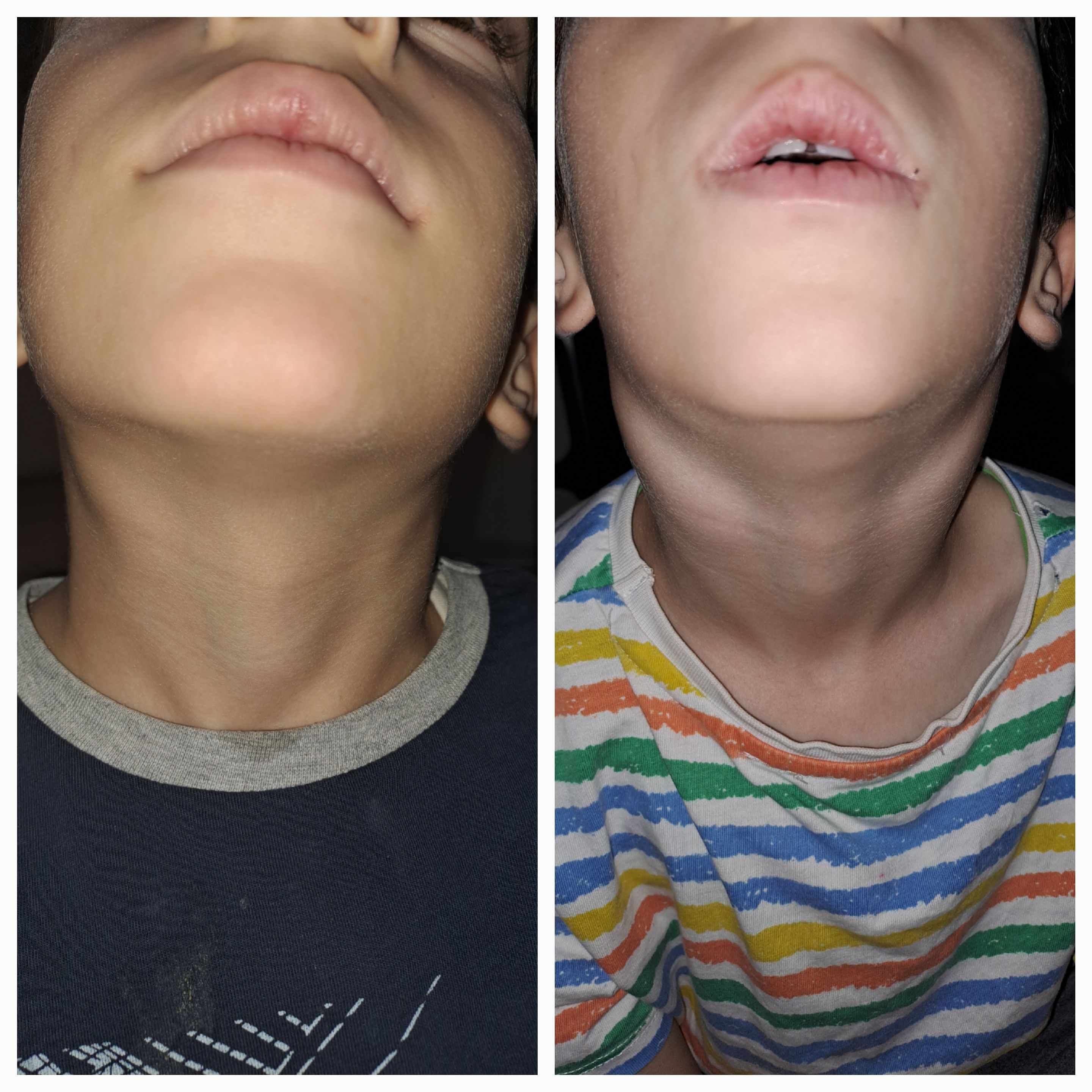 انتفاخ بالعقد اللمفاوية بالرقبة للاطفال: 5 أسباب