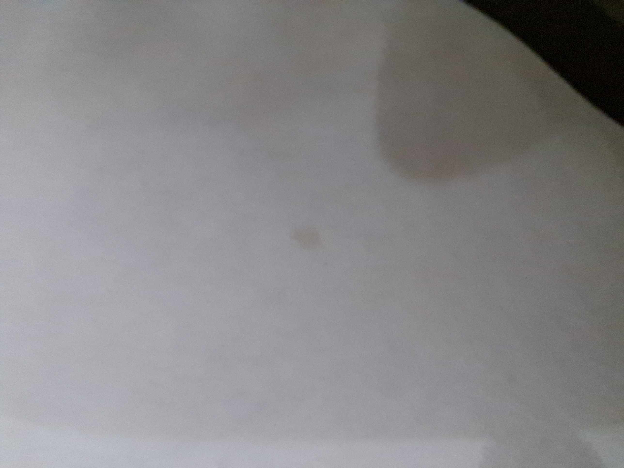 متى تبدأ أعراض بقع القهوة بحليب؟