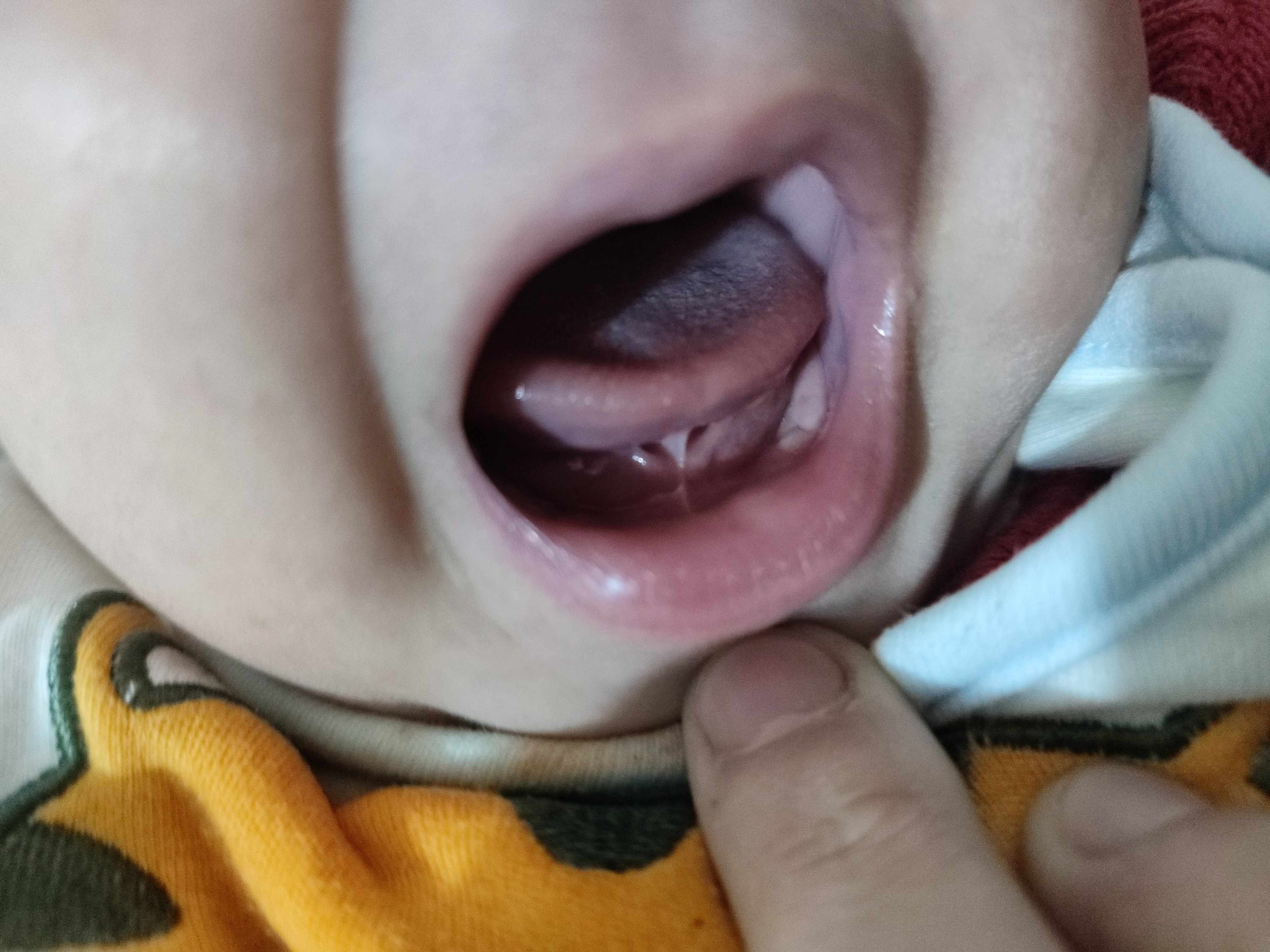 هل عملية اللسان المربوط ضرورية أو خطيرة