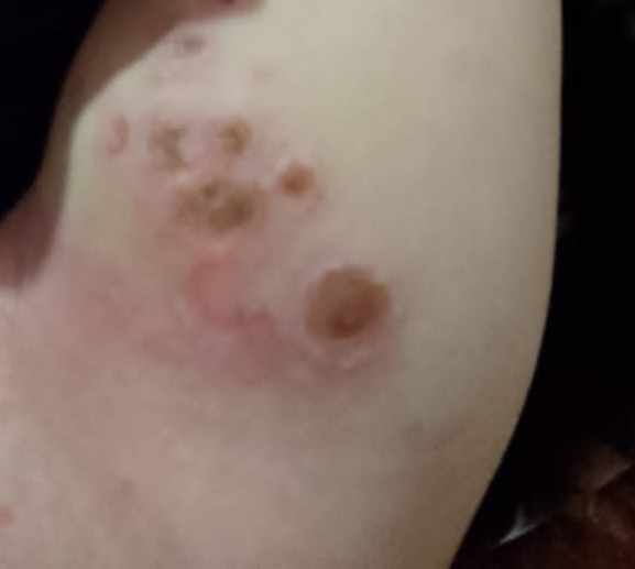 ظهور قرح في الفخذ الايسر للطفل