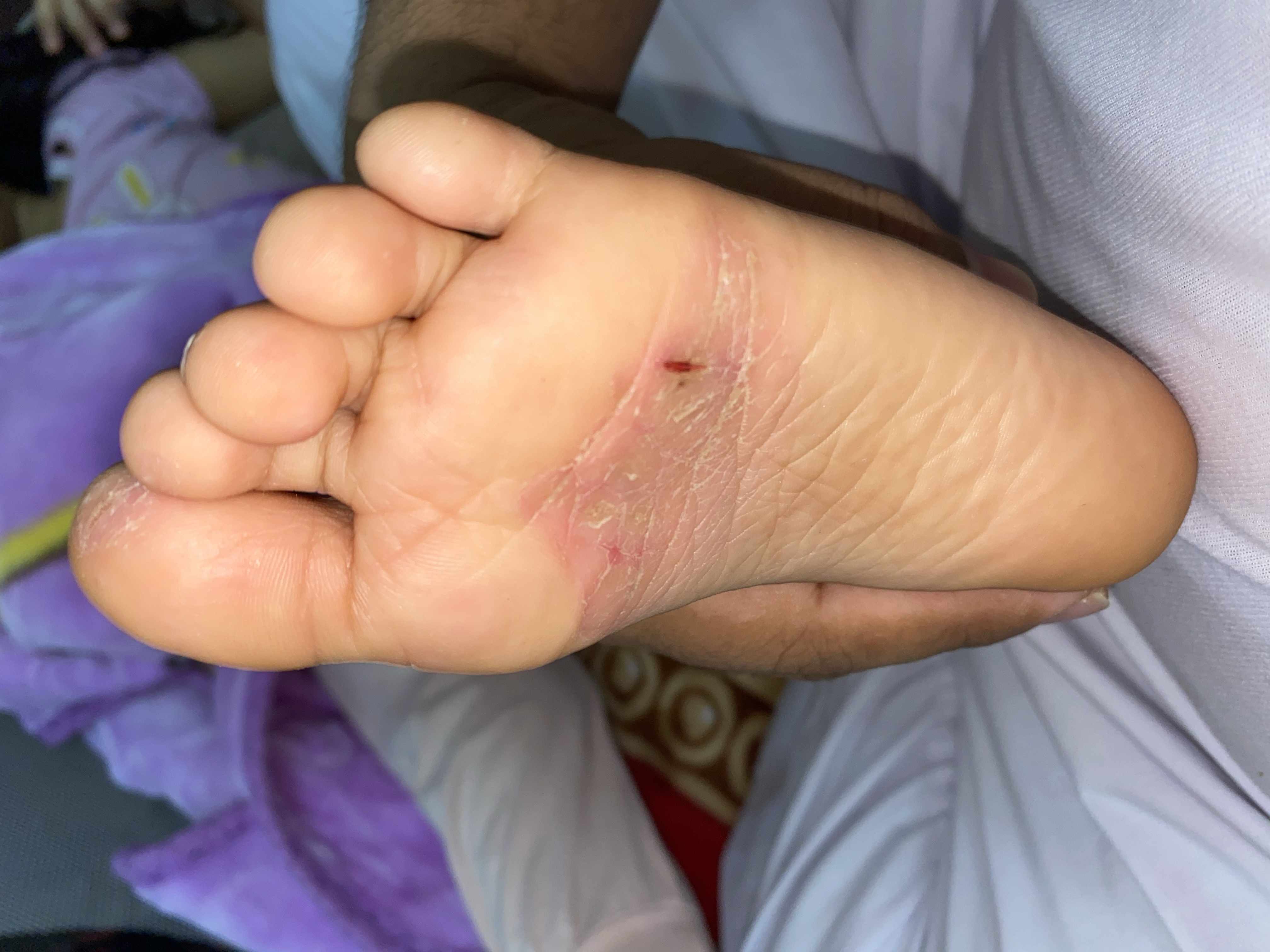 احمرار في جلد اسفل القدم مع تشققات