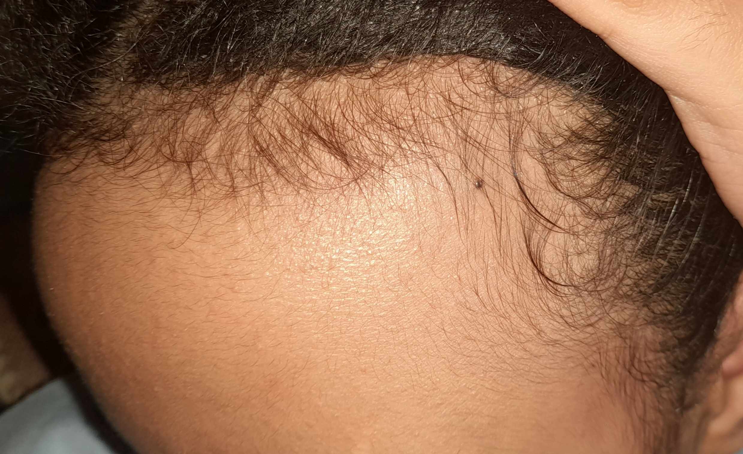 أسباب تراجع شعر الجبين الأمامي عند البنات
