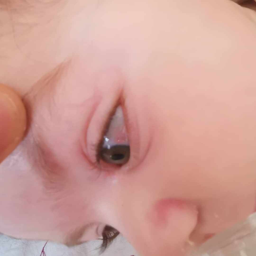 كتلة بيضاء محمرة في عين الرضيع