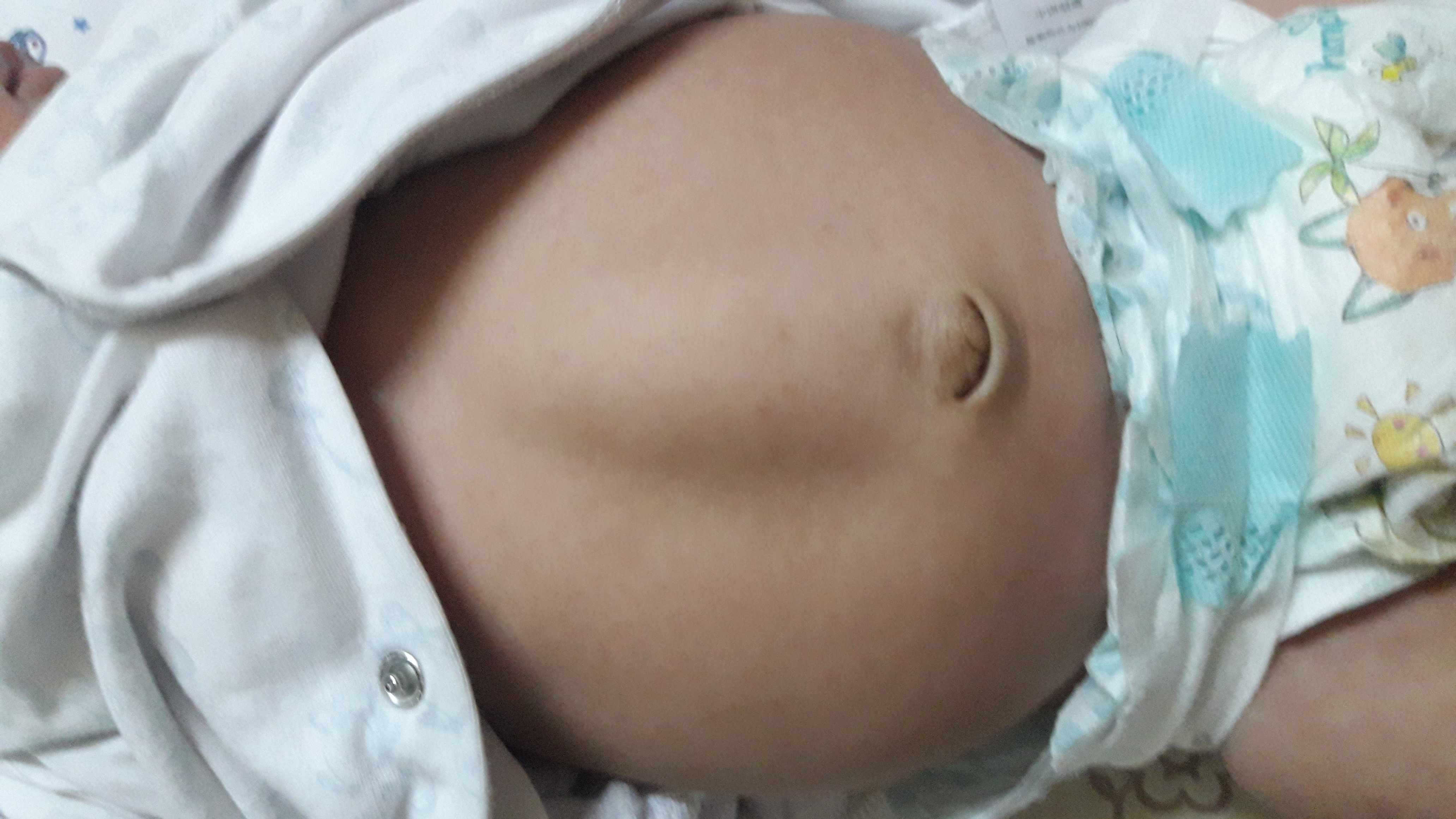 فتق الخط الأبيض عند الأطفال