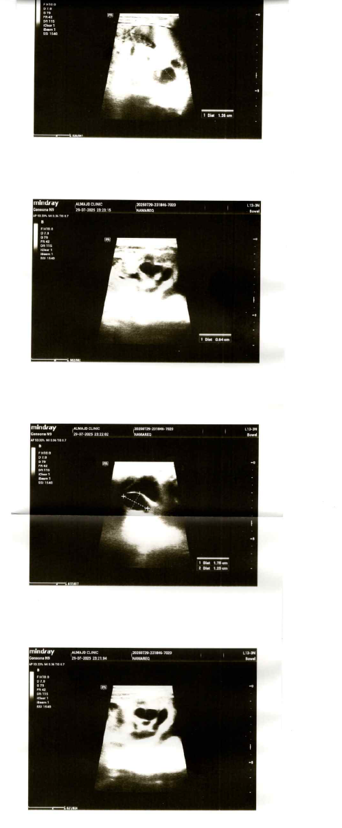 تشوه توسع خلقي في الحالب