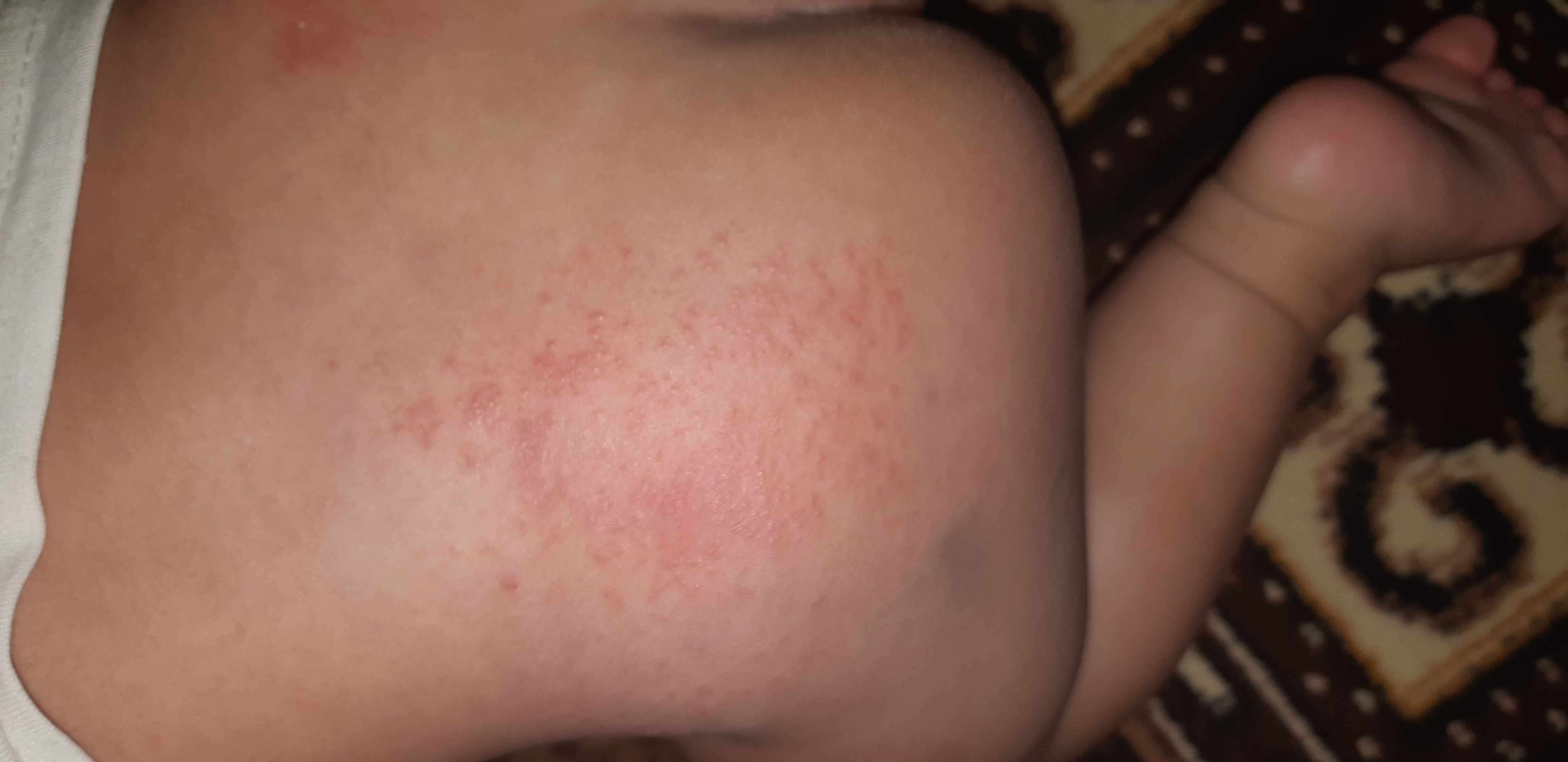 وجود حبوب في منطقه الخصر تحت الحفاض