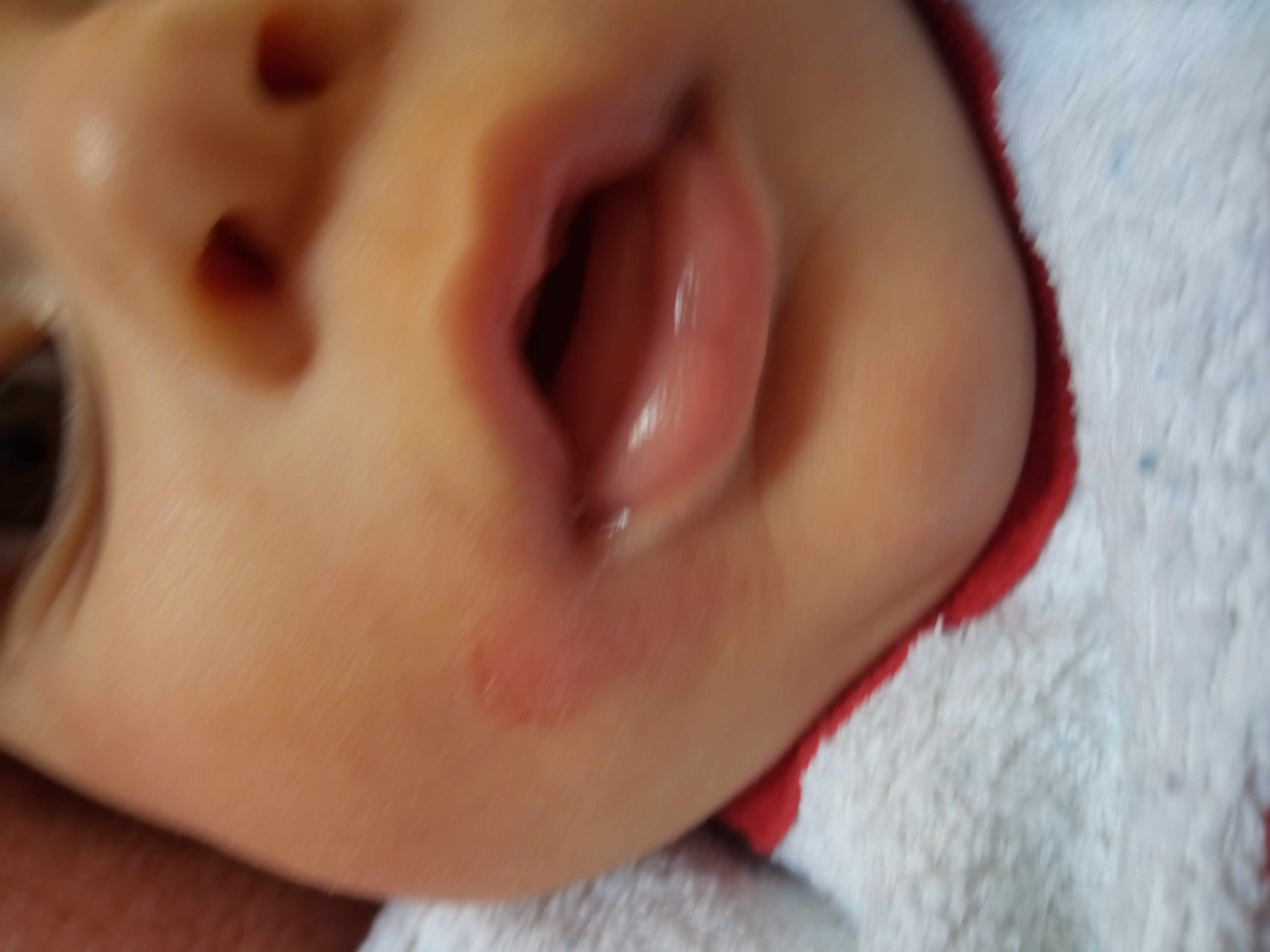 بقعة حمراء بجانب فم الطفل