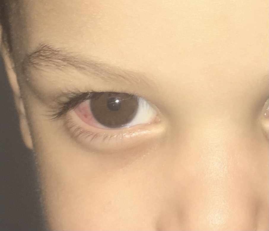 عين طفلي محمرة