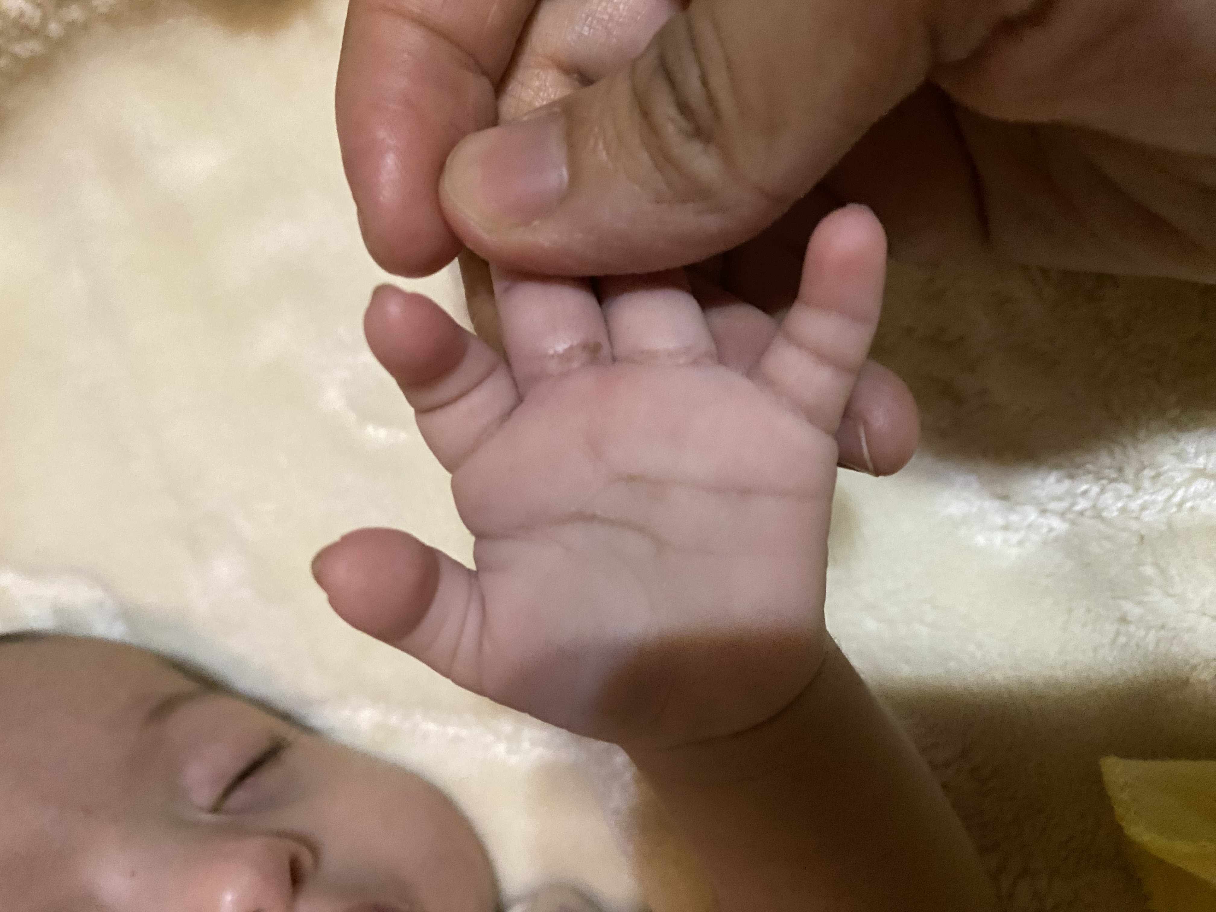هل خطوط كف اليد تدل على متلازمة