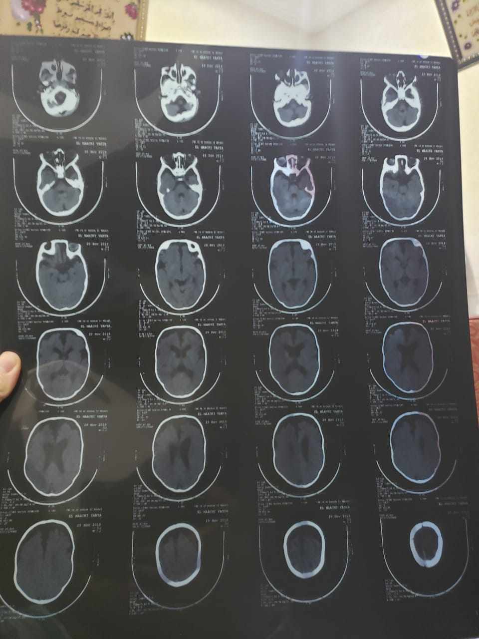 زيادة سريعة في حجم راس طفلي