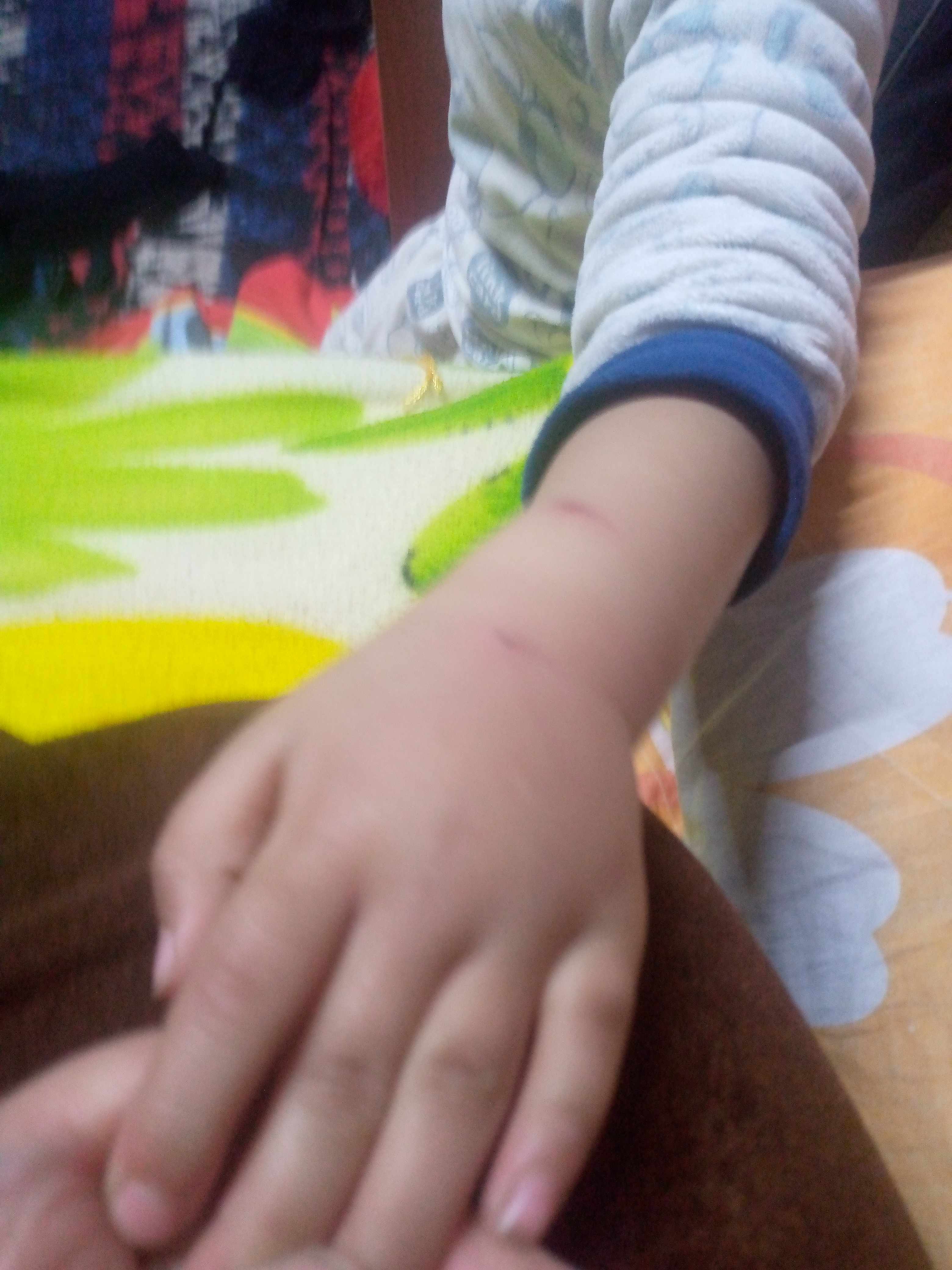 توذم و تورم يد الطفل بسبب جرح سطحي