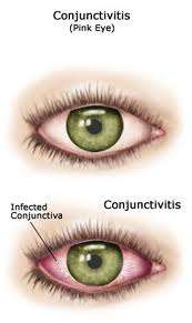 التهاب العين و الملتحمة للاطفال