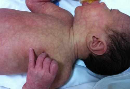 الجلد المرمري عند الاطفال حديثي الولادة "Cutis Marmorata"