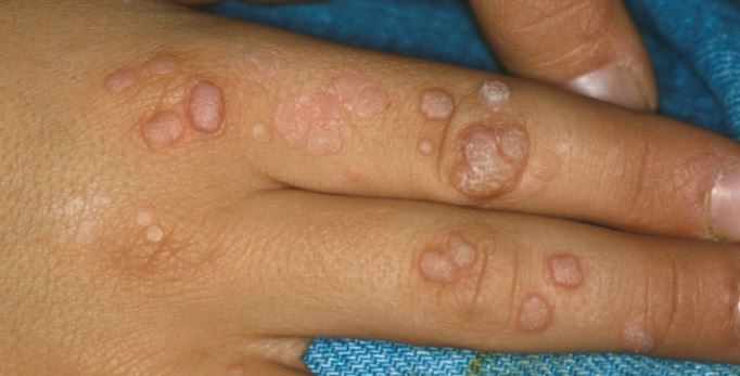 تشخيص ومعالجة الثآليل الجلدية