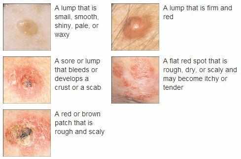 علامات سرطان الجلد المبكرة