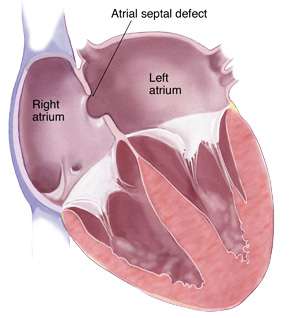 فتحة القلب بين الأذينين atrial septal defect - ASD