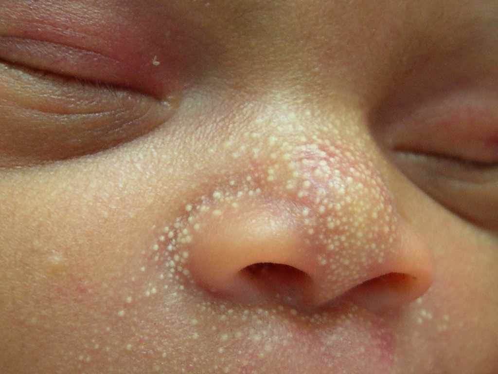 فرط التنسج الزهمي عند حديث الولادة 'Sebaceous Hyperplasia'
