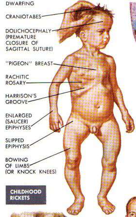 نقص فيتامين د عند الرضع و الأطفال