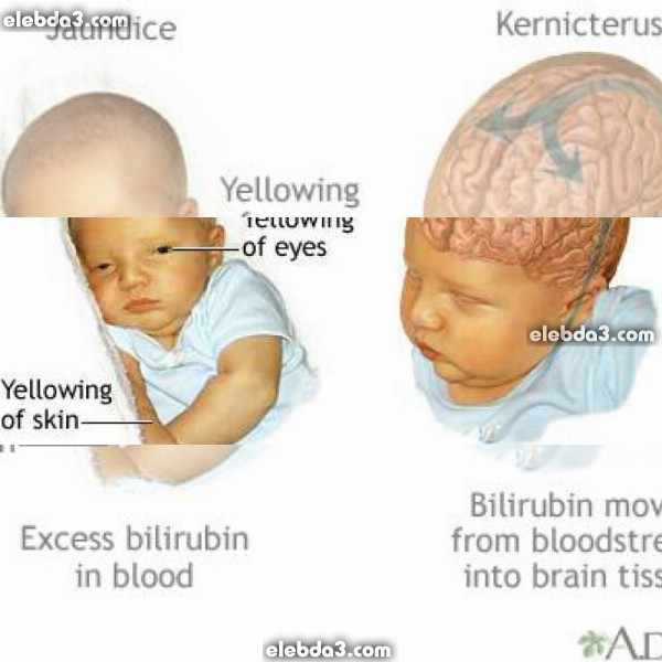 كيف يحدث الاصفرار و اليرقان عند الوليد