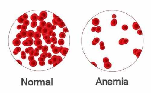 أسباب نادرة لفقر الدم و الأنيميا بسبب خلل داخل الكريات الحمر