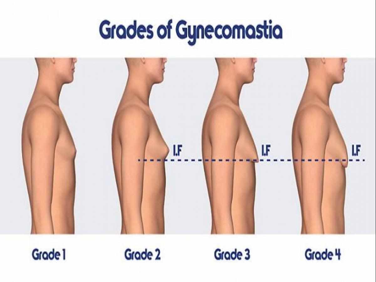 أسباب وعلاج كبر حجم الثدي للرجال
