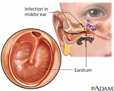 أعراض التهاب الأذن الوسطى عند الأطفال