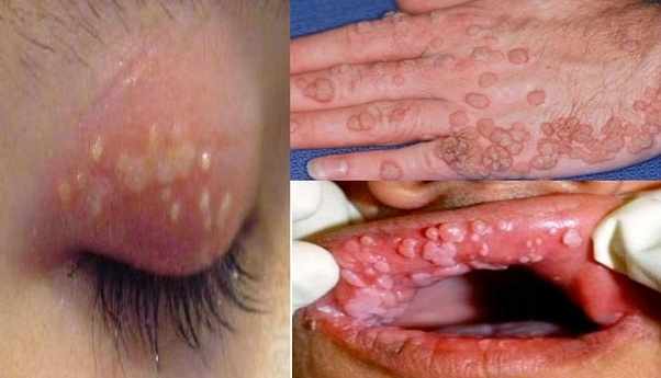أعراض فيروس الورم الحليمي البشري