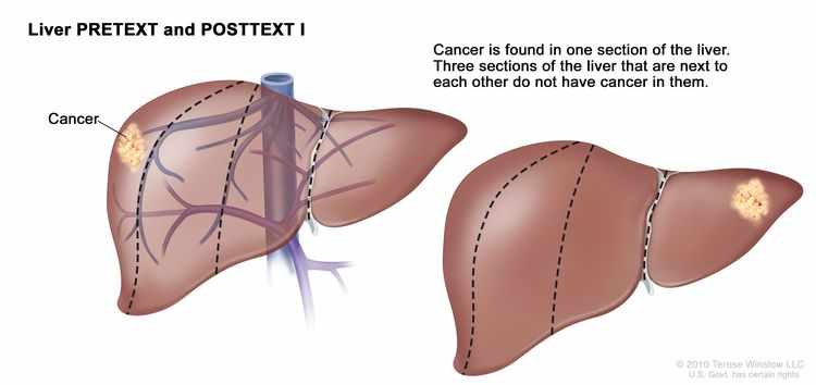 أنواع سرطان الكبد عند الاطفال