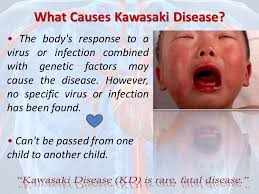 اسباب مرض كاواساكي عند الاطفال