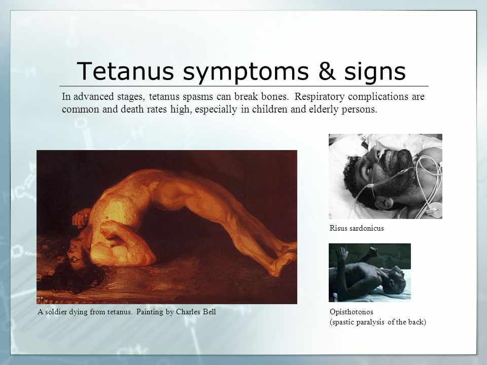 اعراض الكزاز التيتانوس عند الاطفال