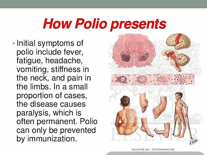 اعراض شلل الاطفال