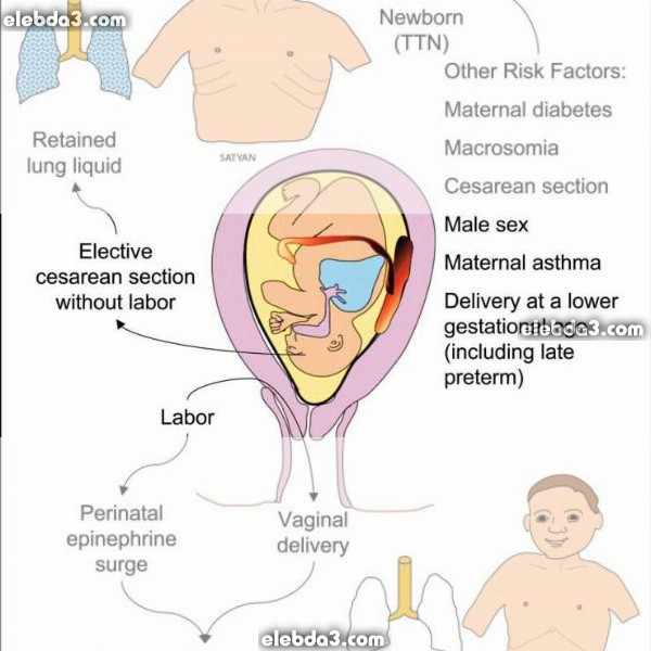 اعراض و تشخيص ارتفاع التوتر الرئوي المستمر عند الوليد