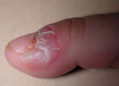 التهاب الإصبع البعيد النفاطي