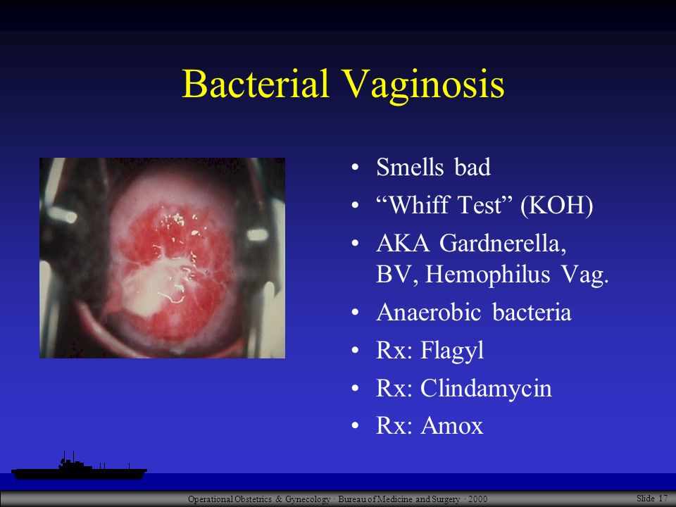 التهاب المهبل البكتيري او الجرثومي