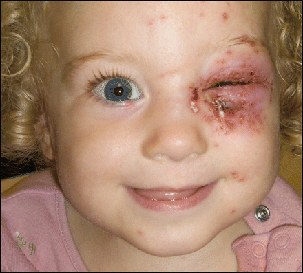 التهاب النسيج الخلوي و الجلد حول الحجاج و العين