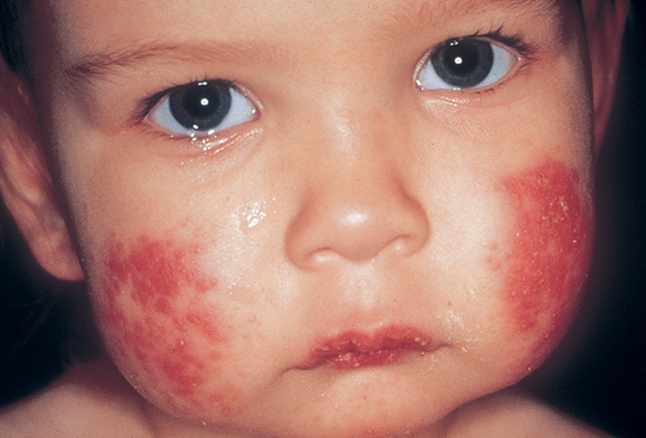 التهاب جلد الأطراف الحطاطي عند الأطفال