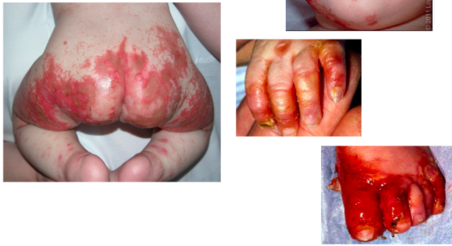 التهاب جلد الاطراف عند الاطفال و الرضع