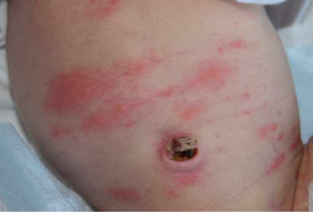 الحمامى السمية عند الطفل المولود "Erythema Toxicum"