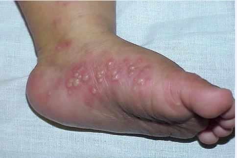 الداء البثري الرضيعي في الاطراف"Infantile Acropustulosis"