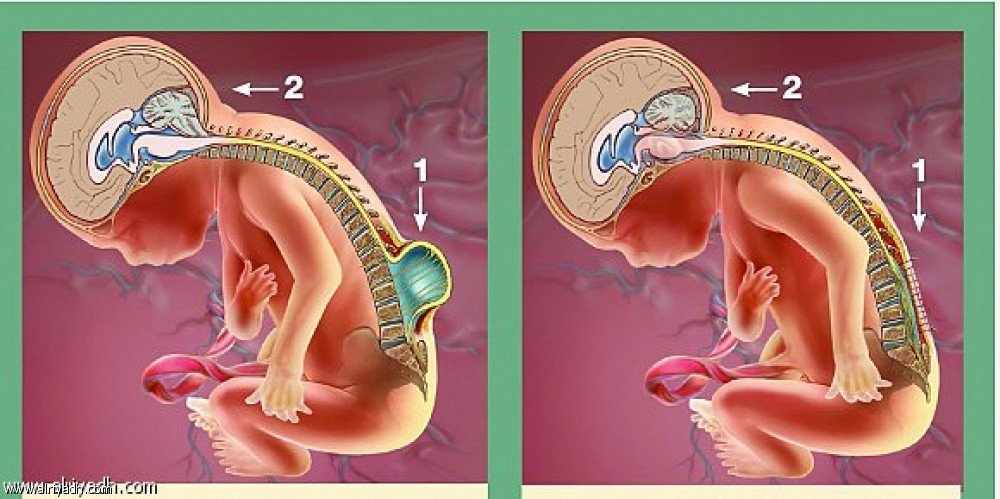 كسر الفقرات و انقطاع النخاع للطفل خلال الولادة