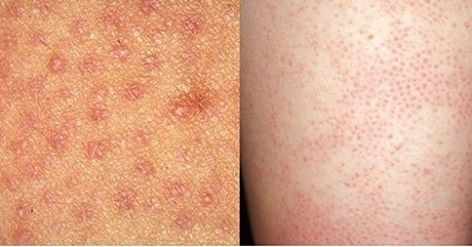 العوامل الحالة للقرنين" Keratolytic Agents"